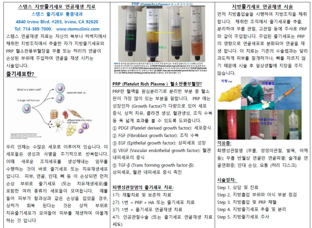 지방줄기세포 연골재생 치료 과정